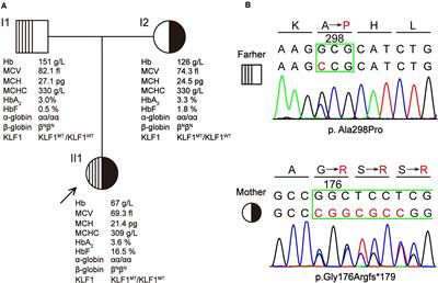 Compound Heterozygosity for KLF1 Mutations Causing Hemolytic Anemia in Children: A Case Report and Literature Review